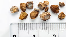 Kidney Stones on the Rise: Where Are the Specialists?