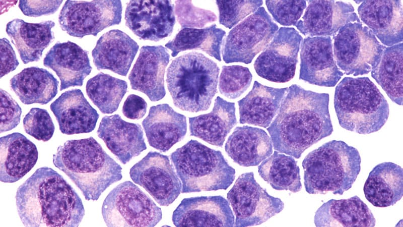 New Multiple Myeloma Staging Systems Outperform the Standard