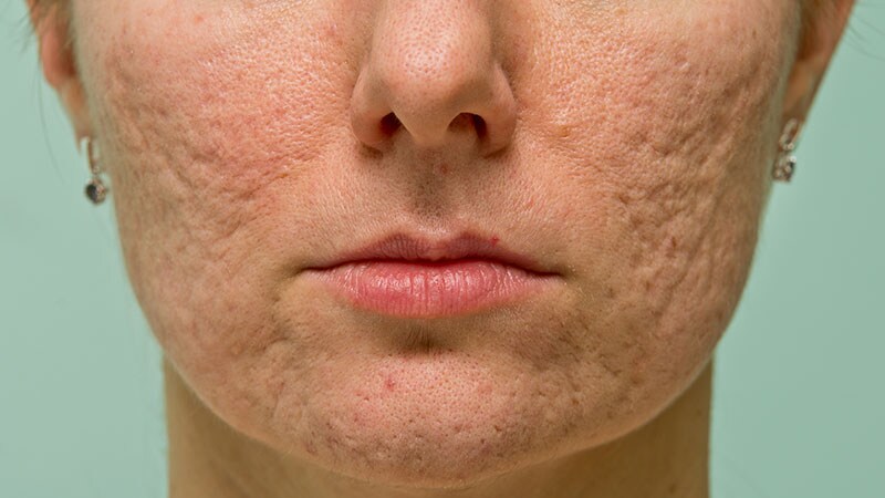 Acne Stigma Persists Across Social and Professional Settings