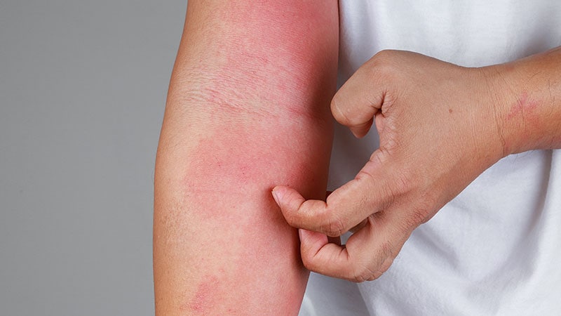 Paradoxical Eczema Risk Low With Biologic Psoriasis Tx