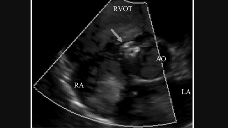 Transcatheter Tricuspid Repair Improved Quality of Life