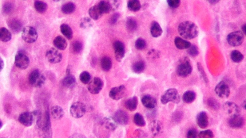 In Real World, Patients With Myeloma Have Worse Outcomes