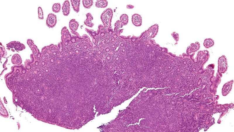 Mantle Cell Lymphoma: Drug Combo Improves PFS